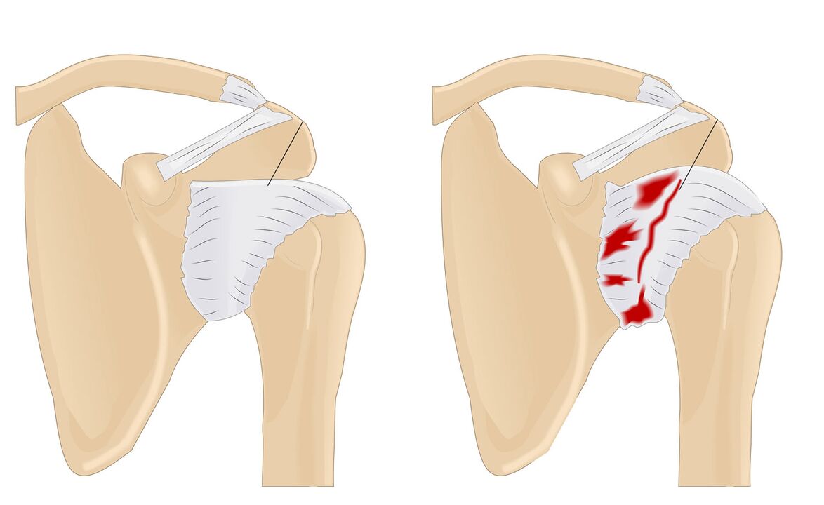 articulación normal e afectada